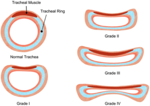 Sagging trachea ring illustration 